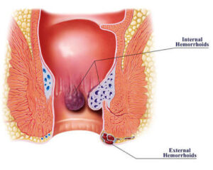 Best Piles Treatment in Nagpur: Find the Right Piles Doctor Near You