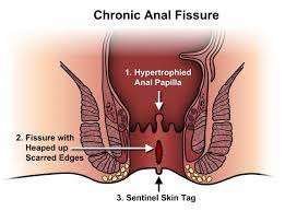 Best Fissure Treatment in Nagpur: Find the Right Fissure Doctor Near You